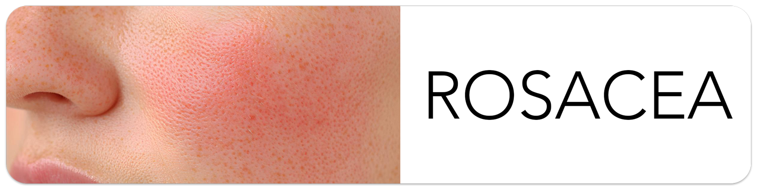 slide4 rosecea