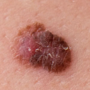 spots Highly Atypica Nevus