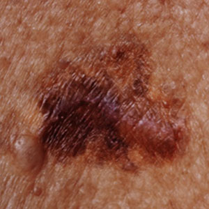 spots Melanoma